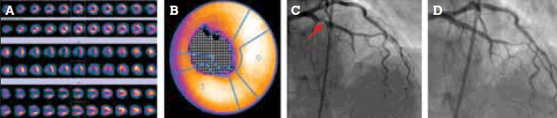 Figure 4. Ischaemia of apical, distal anterior and septal segments on (a) MPS; (b) automated analysis; and (c) coronary angiography (with arterial stenosis indicated by arrow). The lesion was stented (d)