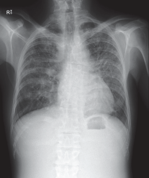 Figure 1. Chest X-ray demonstrating bilateral symmetrical hilar lymphadenopathy and reticular opacities