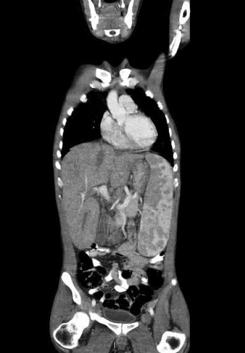 Figure 2. Coronal CT abdomen demonstrating marked hepatosplenomegaly