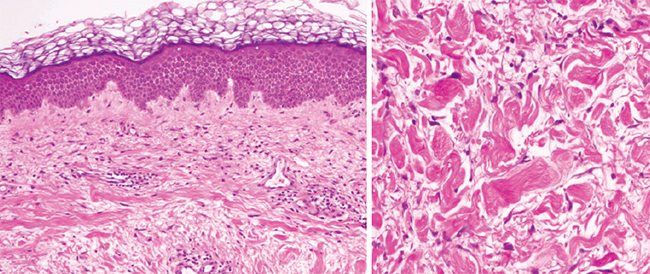 Figure 2. Haematoxylin–eosin staining showing increased thickness of the dermis
