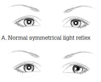 Figure 1. The light reflex test