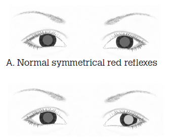 Figure 2. The red reflex test