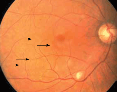 Figure 1. Right fundus image of the posterior pole,
demonstrating multiple retinal emboli (marked by
arrowheads), an inferotemporal cottonwool spot
and early arteriolar attenuation