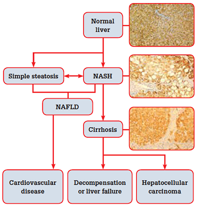 Figure 1. The natural history of non-alcoholic fatty liver disease