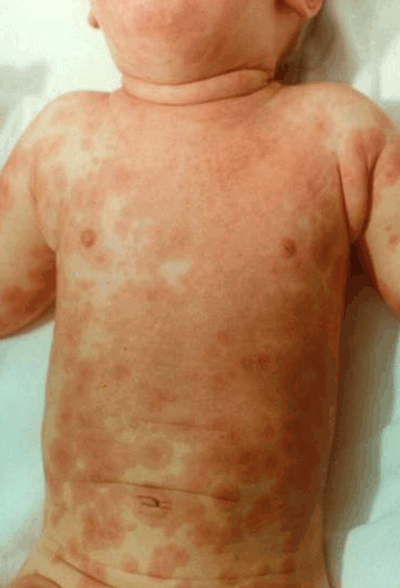 Figure 1. Polymorphous skin rash affecting the trunk in a child with confirmed Kawasaki disease