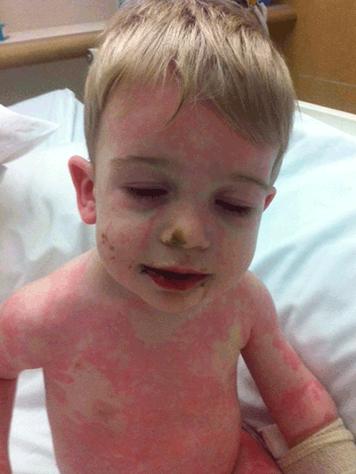 Figure 2. Dry, red lips and polymorphous rash in a child with confirmed Kawasaki disease