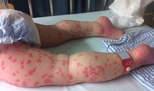 Figure 3. Extremities demonstrating erythema, oedema and rash in a child with Kawasaki disease