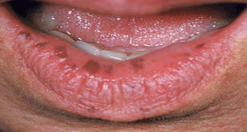Figure 1. The patient’s lower lip