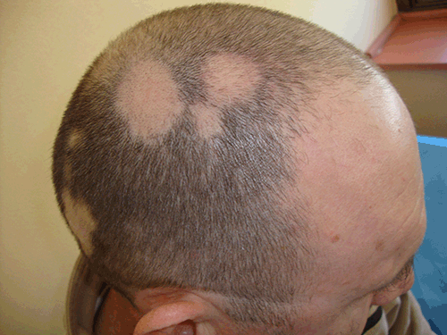 Figure 2. Multiple circular patches of alopecia areata in a man aged 42 years