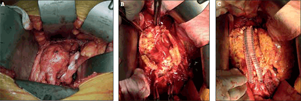 Figure 2. Open repair of infrarenal abdominal aortic aneurysm