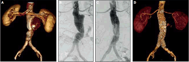Figure 3. Endovascular repair of an infrarenal abdominal aortic aneurysm