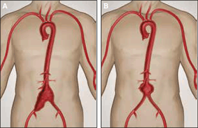 Figure 4a. Aortoiliac aneurysm involving the infrarenal aorta and right common iliac aneurysm Figure 4b. Infarenal aortic aneurysm