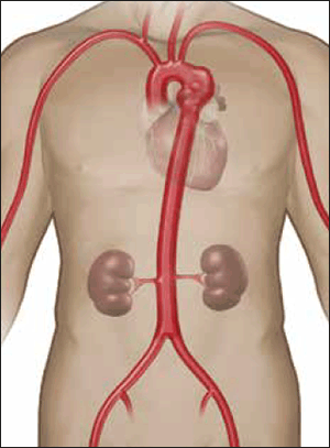 Figure 5. Descending thoracic aortic aneurysm located just distal to the left subclavian artery
