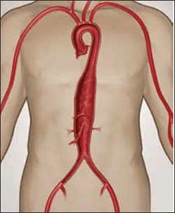 Figure 6. Crawford Type 3 thoracoabdominal aneurysm