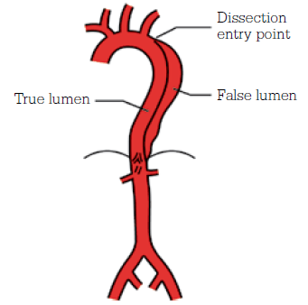 Figure 7. Stanford Type B aortic dissection