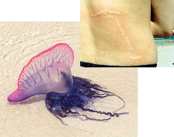 Figure 1. Bluebottle and (inset) appearance of bluebottle sting