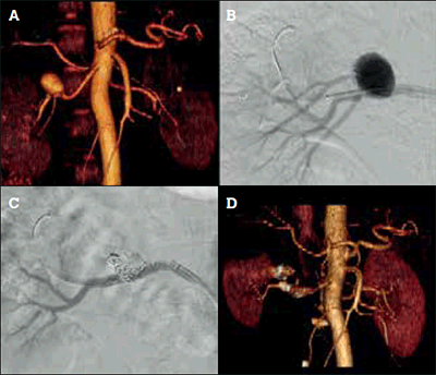 Figure 4. Endovascular treatment of a 2.5 cm right renal artery aneurysm