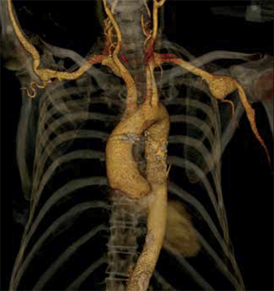 Figure 5. CT angiogram reconstruction of an axillary artery aneurysm in a patient with Marfan syndrome