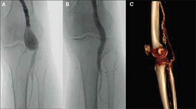 Figure 6. Open and endovascular treatment of popliteal aneurysms