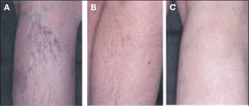 Figure 4. CEAP 1 veins: Results of sclerotherapy