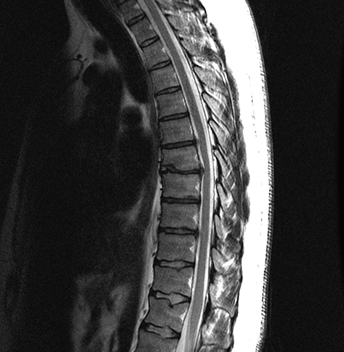 Figure 2. MRI of the thoracic spine (1.5T). 
Sagittal fast spin echo T2 weighted image 
shows chronic degenerative changes in 
intervertebral discs, with osteophytes, 
dehydration and height loss. There are 
small disc protrusions at T5–T6 and 
T8–T9 and a disc herniation at T6–T7 
obliterating the anterior subarachnoid 
space and deforming the spinal cord 
without signal intensity changes