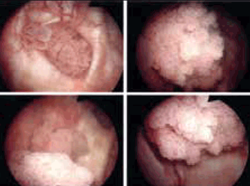 Figure 2. Endoscopic view of bladder tumours