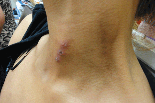Figure 1. The neck of a patient who has  been injecting the 
  oxycodone her GP had been rescribing  to her mother for 
cancer pain