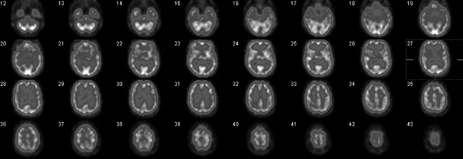 Figure 1. Normal cerebral perfusion, transaxial slices. Radiotracer uptake is consistent (and 
symmetrical) throughout the cortical and subcortical grey matter