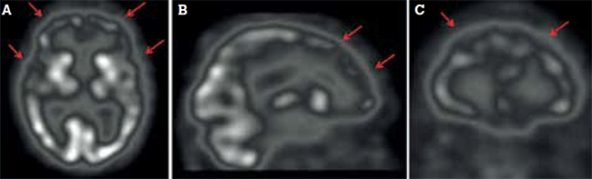 Figure 3. Frontal and temporal hypoperfusion (arrows), paralleling neuronal degeneration 
in frontotemporal dementia, shown in (A) transaxial, (B) sagittal and (C) coronal views 