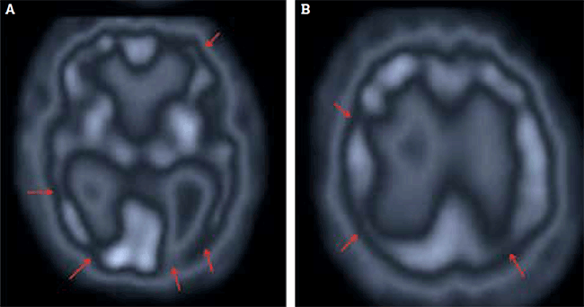 Figure 4. Cerebral perfusion studies in multi-infarct dementia typically show bilateral 
scattered areas of hypoperfusion throughout the cortex (arrows) in (A) inferior and (B) 
superior sections