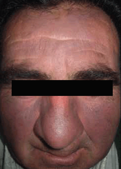 Figure 1. Blue-grey hyperpigmentation on sun-exposed skin of the face