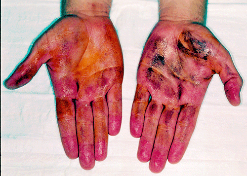 Figure 2. The starch-iodine test. Iodine is applied to a dry
area of skin and starch is sprinkled on top. The iodine,
starch and sweat react to form the dark sediment. The left
palm has not yet been treated with iontophoresis