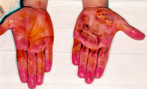 Figure 3. Starch-iodine test after a patient has had
iontophoresis to the left palm 7 days earlier. The image
demonstrates a reduction in perspiration