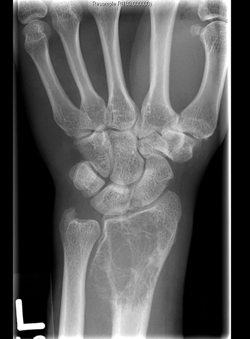Figure 2. Plain X-ray of the patient’s left
wrist