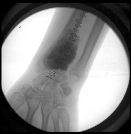 Figure 3. Intra-operative X-ray of the
wrist showing curettage of the GCTB
and packing with PMMA bone cement