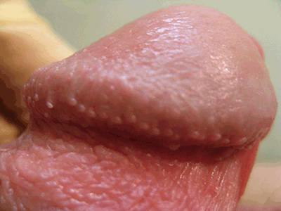 Figure 1. Pearly penile papules