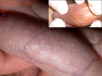 Papules vs herpes penile Pearly penile
