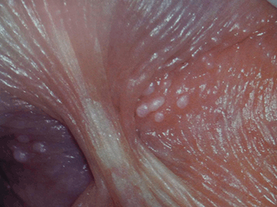 RACGP - Penile appearance, lumps and bumps