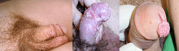 Figure 6. Penile warts