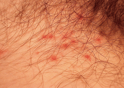 Penile whiteheads shaft on Pimple or