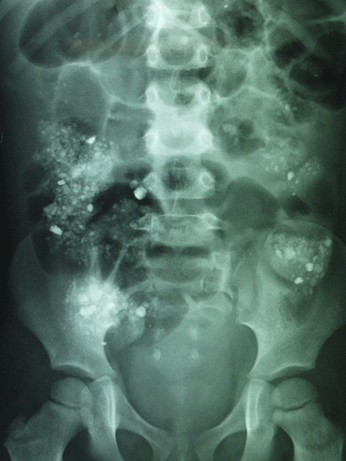 Figure 1. Abdominal X-ray displaying
typical features of soil pica. The X-ray
opacities are mainly in the colon