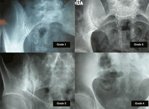 Figure 2. Radiographic grading of sacroiliac joints