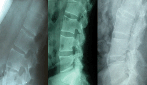 Figure 3. Lumbar spine changes in AS