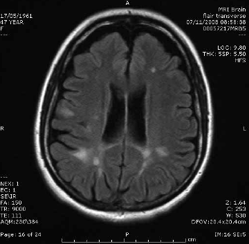 Figure 1. Multiple sclerosis.