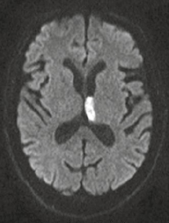 Figure 3. Diffusion-weighted imaging showing acute (white signal) infarct involving the left thalamus