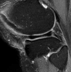 Figure 2. MRI scan 6 months later