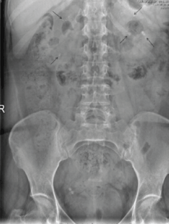 Figure 1. Abdominal X-ray in which multiple and bilateral calcium foci are observed in both renal units