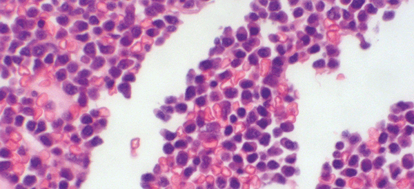 Figure 1B. Trephine showing infiltration with malignant plasma cells