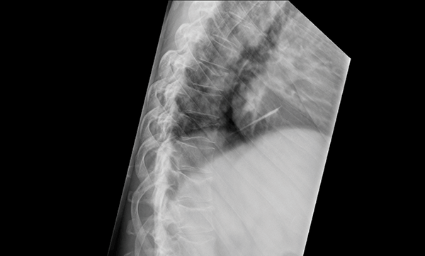 Figure 2. Thoracic spine x-ray demonstrating multiple wedge compression insufficiency fractures typical of myeloma