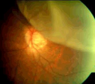 Figure 3. Retinal detachment superiorly
